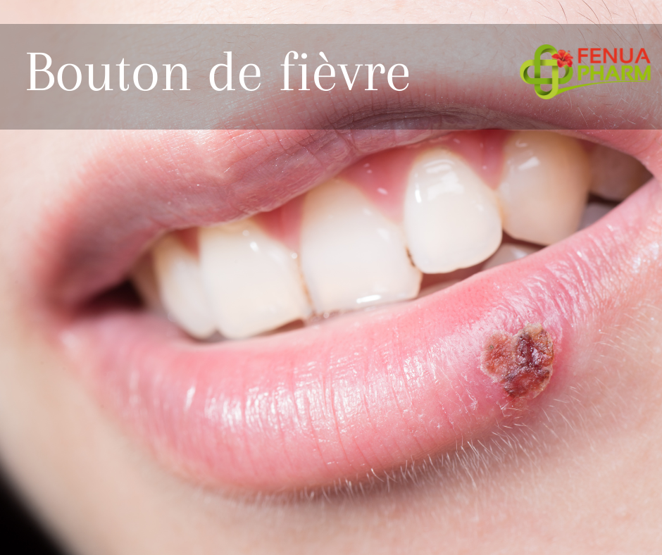 Bouton de fièvre GIE Fenua Pharm