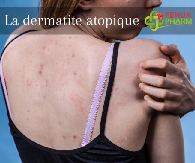 Dermatie atopique