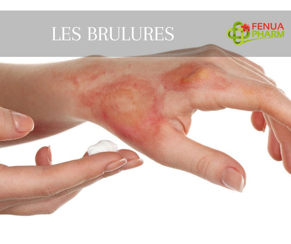 Les brûlures GIE Fenua Pharm